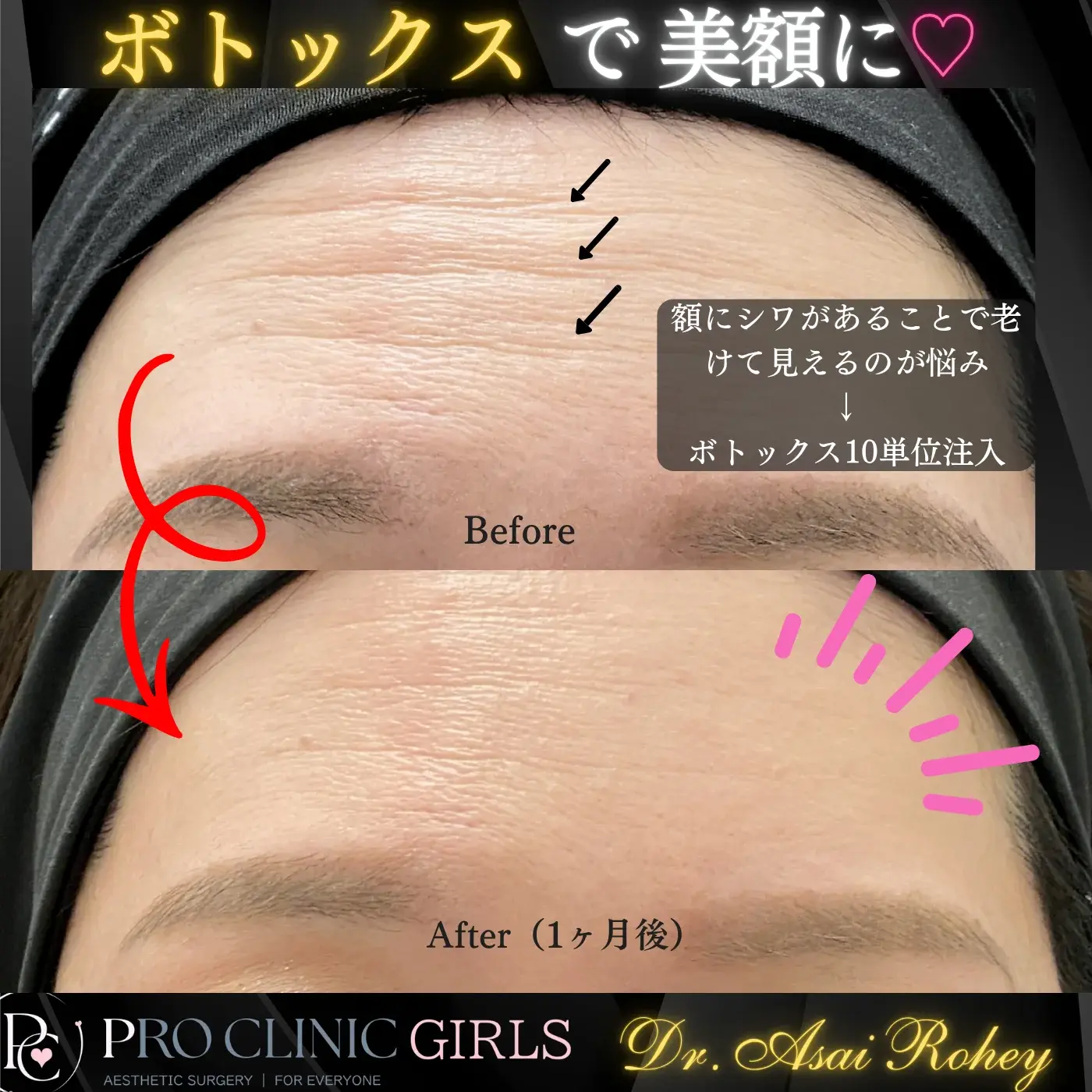プロクリニックの額ボトックス注入の症例(1ヶ月後・正面)