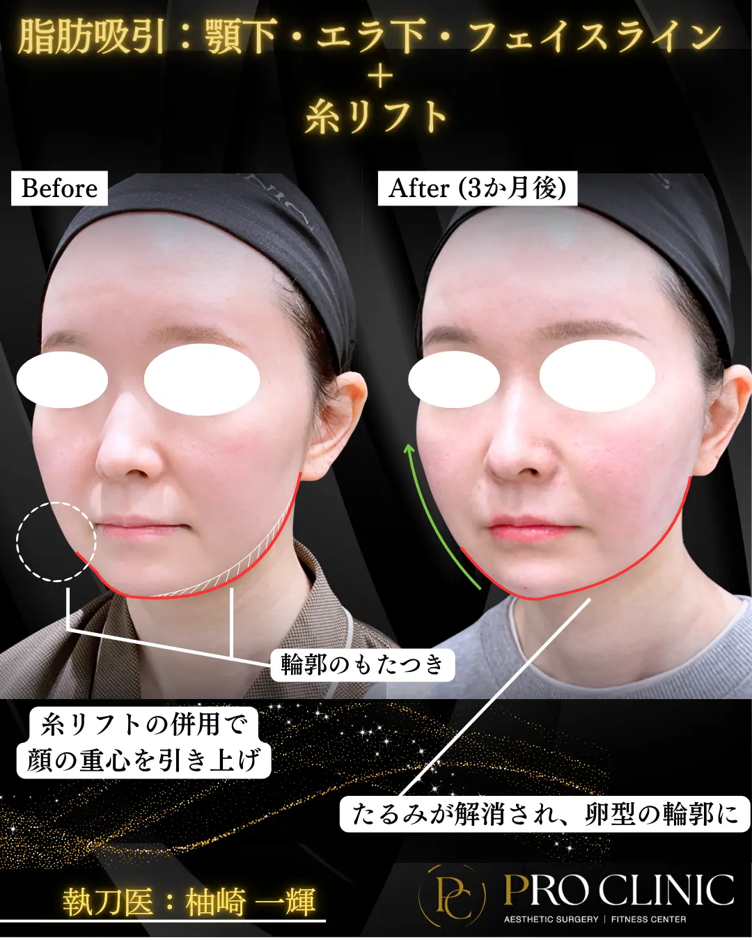 プロクリニックの脂肪吸引（顔）と糸リフトの症例（3ヶ月後）