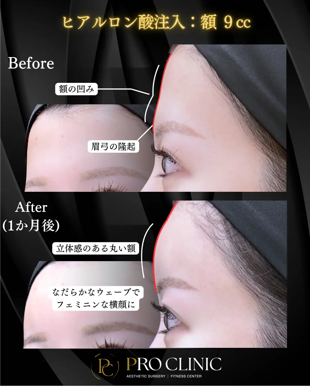 プロクリニックのヒアルロン酸注入（額）の症例（1か月後・斜角/側面）