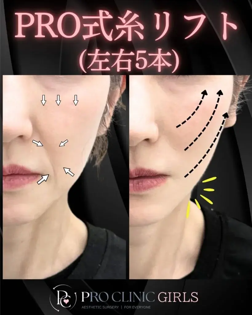 プロクリニックの糸リフト（左右各5本）の症例（1ヶ月後）