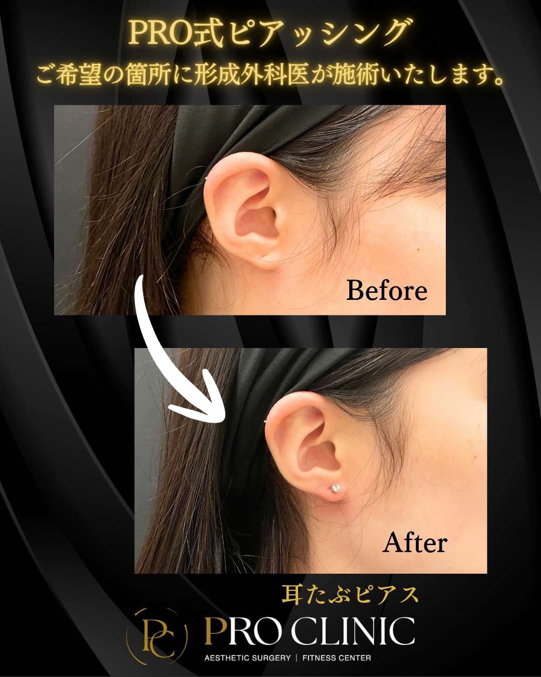 プロクリニックでは形成外科医が耳たぶピアスをおこなっています。