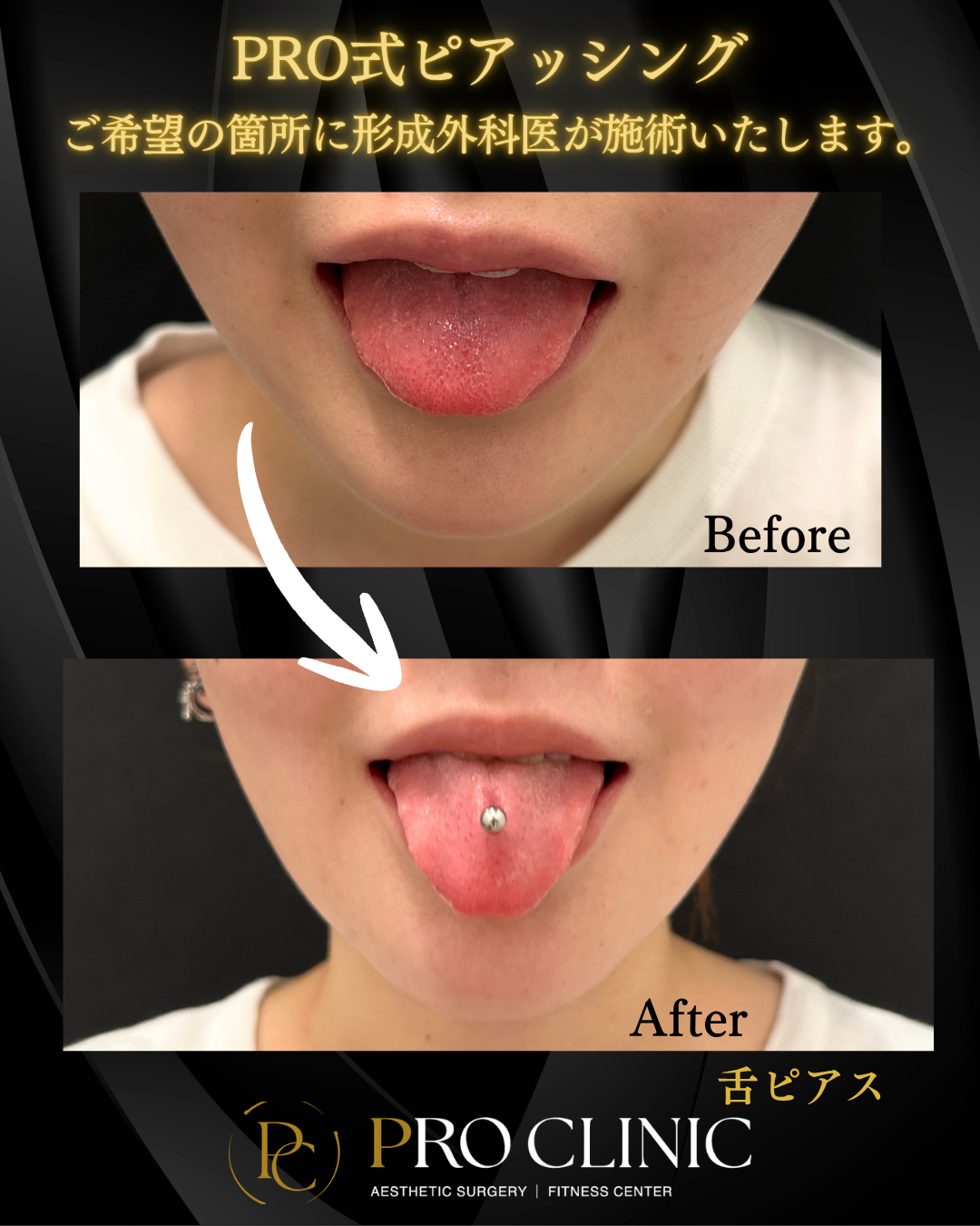 プロクリニックでは形成外科医が舌ピアスをおこなっています。