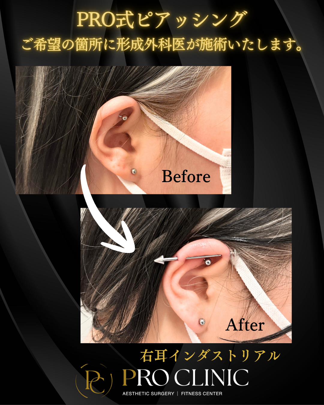 プロクリニックでは形成外科医がインダストリアルピアスをおこなっています。